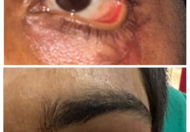 सिम्स में नेत्र की जटिल सर्जरी हुई सफल, स्किन ग्राफ्टिंग कर मरीज का पलक बनाया