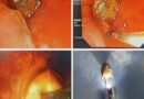 जामुन की गुठली ने युवक की सांस की नली में अटकी, रामकृष्ण केयर में ब्रोंकोस्कोपी से बचाई जान